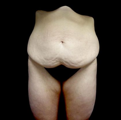 Buttock Augmentation Before & After Patient #24137