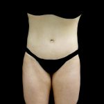 Buttock Augmentation Before & After Patient #24137