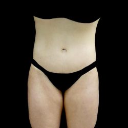 Buttock Augmentation Before & After Patient #24137