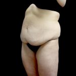 Buttock Augmentation Before & After Patient #24137