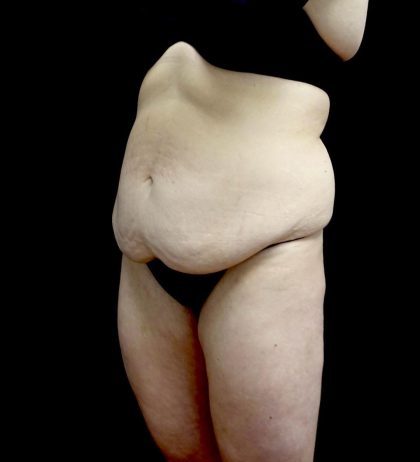 Buttock Augmentation Before & After Patient #24137