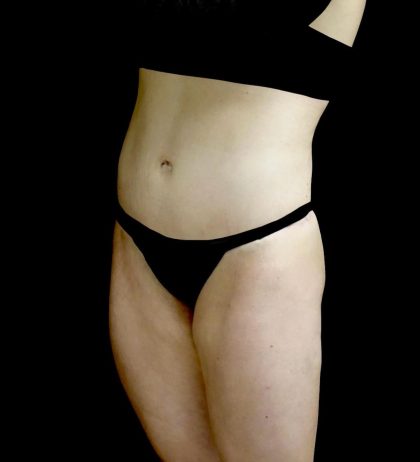 Buttock Augmentation Before & After Patient #24137