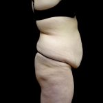 Buttock Augmentation Before & After Patient #24137