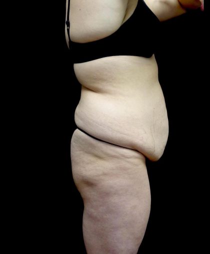 Buttock Augmentation Before & After Patient #24137