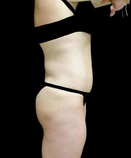 Buttock Augmentation Before & After Patient #24137