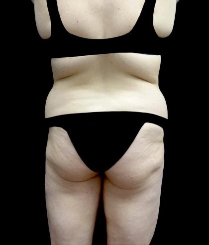 Buttock Augmentation Before & After Patient #24137