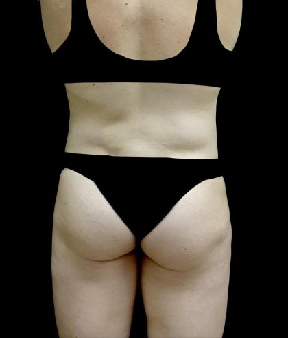 Buttock Augmentation Before & After Patient #24137