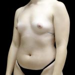 Breast Augmentation (Fat Transfer) Before & After Patient #24138