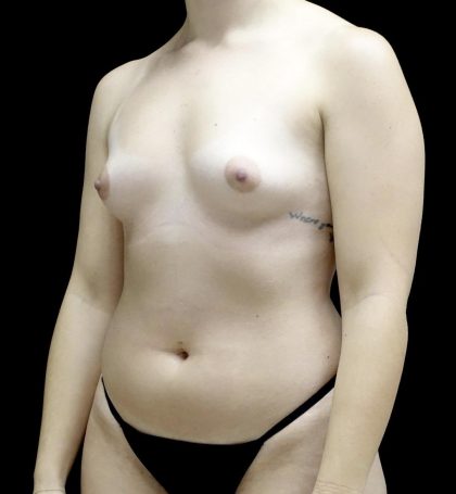 Breast Augmentation (Fat Transfer) Before & After Patient #24138