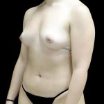 Breast Augmentation (Fat Transfer) Before & After Patient #24138