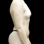 Breast Augmentation (Fat Transfer) Before & After Patient #24138