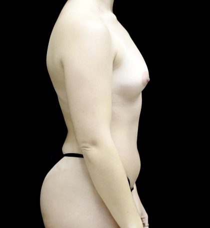 Breast Augmentation (Fat Transfer) Before & After Patient #24138