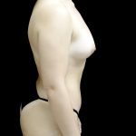 Breast Augmentation (Fat Transfer) Before & After Patient #24138