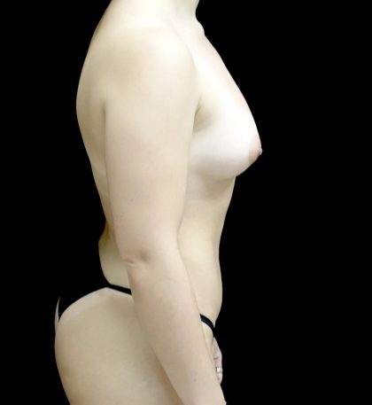 Breast Augmentation (Fat Transfer) Before & After Patient #24138