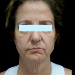 Facelift Before & After Patient #24139
