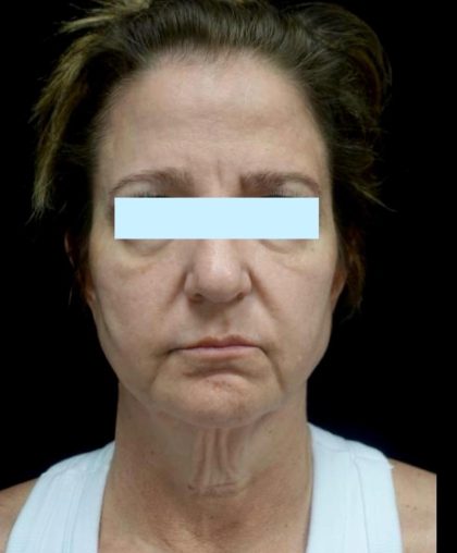 Facelift Before & After Patient #24139