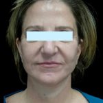 Facelift Before & After Patient #24139