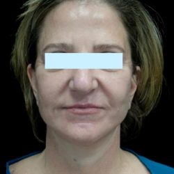 Facelift Before & After Patient #24139