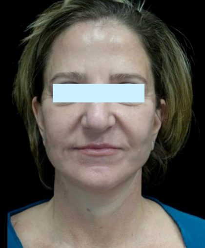 Facelift Before & After Patient #24139