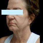 Facelift Before & After Patient #24139