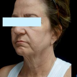 Facelift Before & After Patient #24139