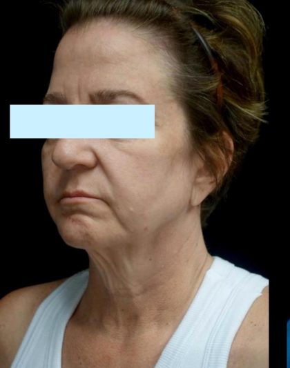 Facelift Before & After Patient #24139