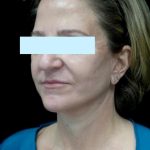 Facelift Before & After Patient #24139
