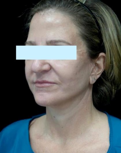 Facelift Before & After Patient #24139