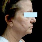 Facelift Before & After Patient #24139