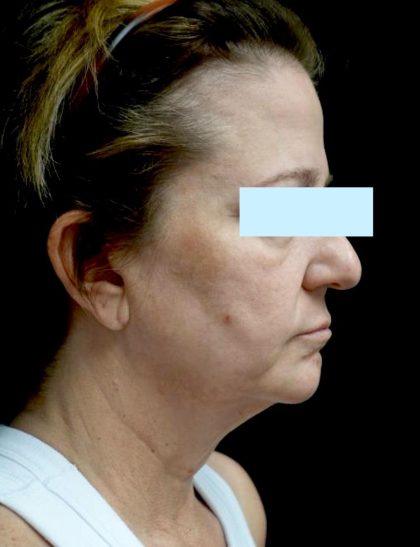 Facelift Before & After Patient #24139