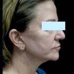 Facelift Before & After Patient #24139