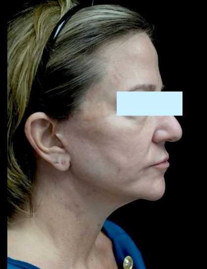 Facelift Before & After Patient #24139