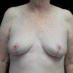 Breast Revision Before & After Patient #24210