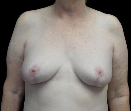 Breast Revision Before & After Patient #24210
