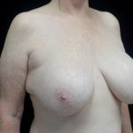 Breast Revision Before & After Patient #24210
