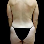 Breast Augmentation (Fat Transfer) Before & After Patient #24243