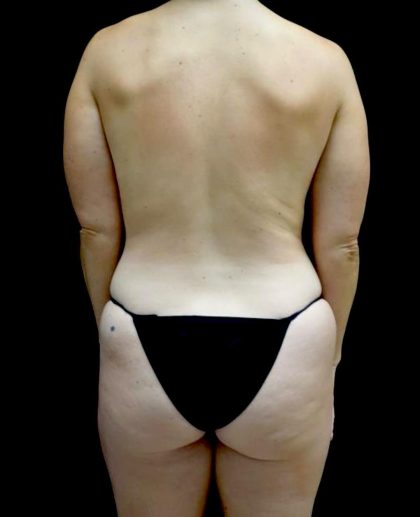 Breast Augmentation (Fat Transfer) Before & After Patient #24243