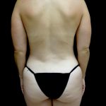 Breast Augmentation (Fat Transfer) Before & After Patient #24243