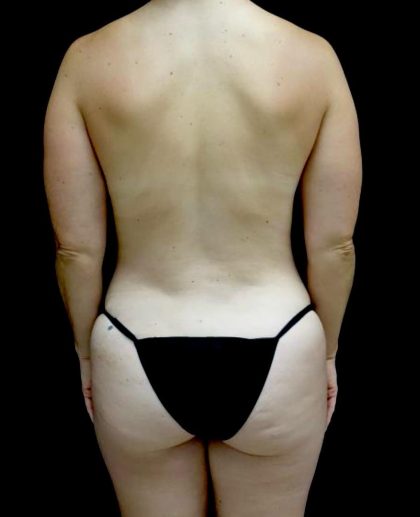 Breast Augmentation (Fat Transfer) Before & After Patient #24243