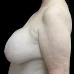 Breast Revision Before & After Patient #24210