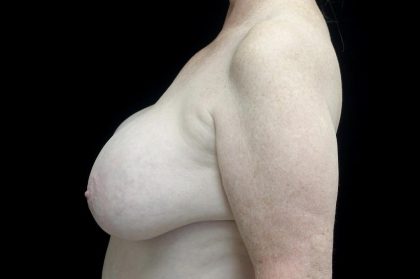 Breast Revision Before & After Patient #24210