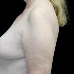 Breast Revision Before & After Patient #24210