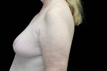 Breast Revision Before & After Patient #24210