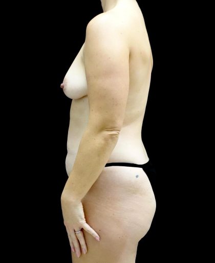 Breast Augmentation (Fat Transfer) Before & After Patient #24243