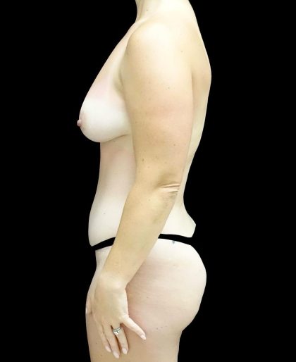 Breast Augmentation (Fat Transfer) Before & After Patient #24243