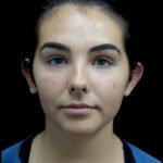 Otoplasty Before & After Patient #24211