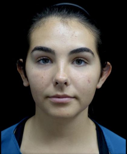 Otoplasty Before & After Patient #24211
