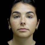 Otoplasty Before & After Patient #24211