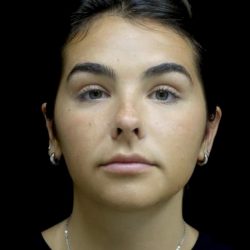 Otoplasty Before & After Patient #24211