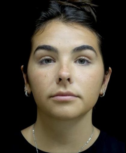Otoplasty Before & After Patient #24211